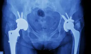 Endoproteza biodra: Rekonwalescencja kiedy wrócisz do życia?
