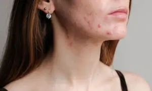 Trądzik na twarzy i szyi. Clindamycin mip 600 na co? Na zmiany zapalne skóry.