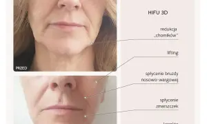 Zabiegi na szyję po 50.: HIFU, RF, stymulatory co wybrać?