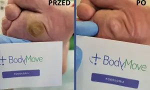 Przed i po zabiegu na odciski na stopach. Widoczna poprawa stanu skóry po interwencji podologicznej.