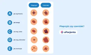Porównanie znamion: pieprzyk vs czerniak. Wczesne wykrycie czerniaka jest kluczowe, bo czy czerniak jest uleczalny? Tak, wcześnie wykryty.