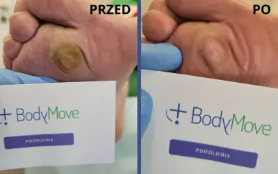Przed i po zabiegu na odciski na stopach. Widoczna poprawa stanu skóry po interwencji podologicznej.