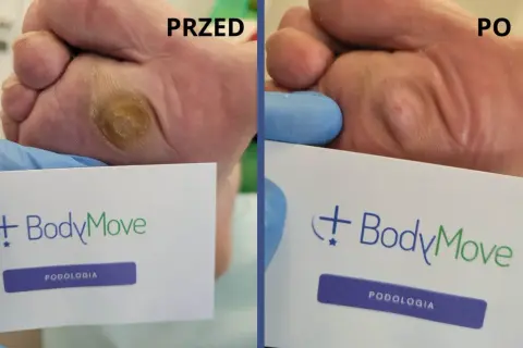 Przed i po zabiegu na odciski na stopach. Widoczna poprawa stanu skóry po interwencji podologicznej.