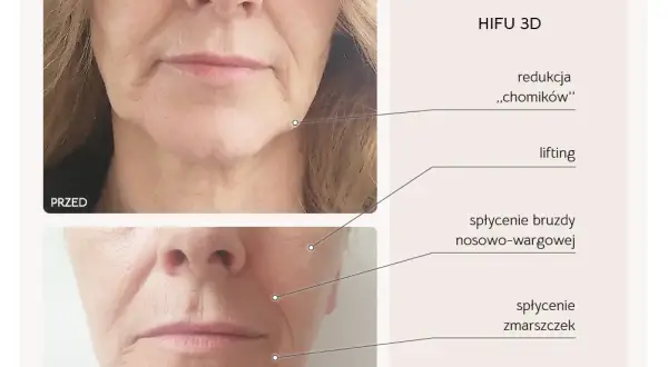 Zabiegi na szyję po 50.: HIFU, RF, stymulatory co wybrać?