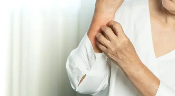 Dłoń drapie zaczerwienioną skórę na ramieniu. Czy to objaw, że candida atakuje?