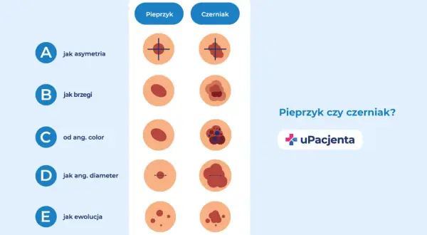 Porównanie znamion: pieprzyk vs czerniak. Wczesne wykrycie czerniaka jest kluczowe, bo czy czerniak jest uleczalny? Tak, wcześnie wykryty.