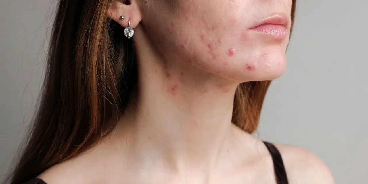 Trądzik na twarzy i szyi. Clindamycin mip 600 na co? Na zmiany zapalne skóry.