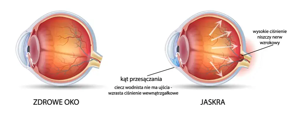 Objawy zaćmy i jaskry infografika
