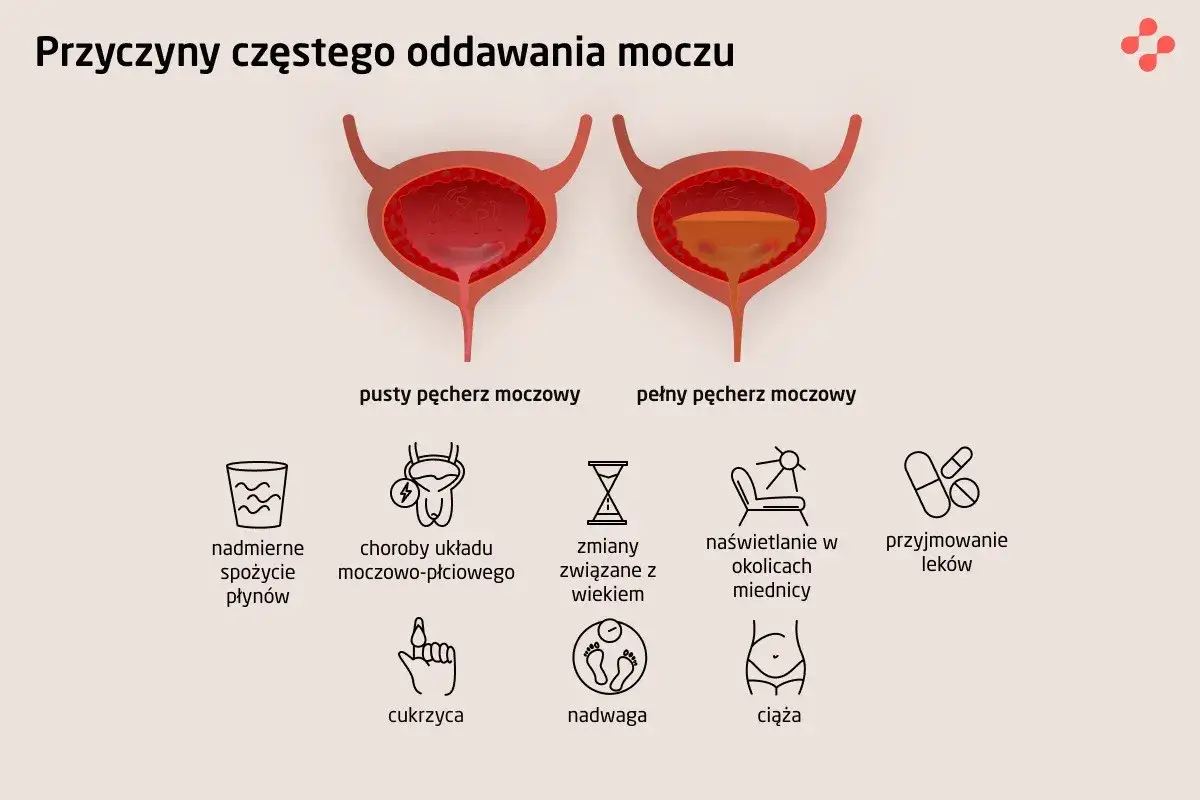 Ilustracja przedstawia przyczyny częstego oddawania moczu, w tym nadmierne picie, choroby, wiek, naświetlanie, leki, cukrzycę, nadwagę i ciążę. Domowe sposoby na zbyt częste oddawanie moczu mogą być związane z tymi czynnikami.
