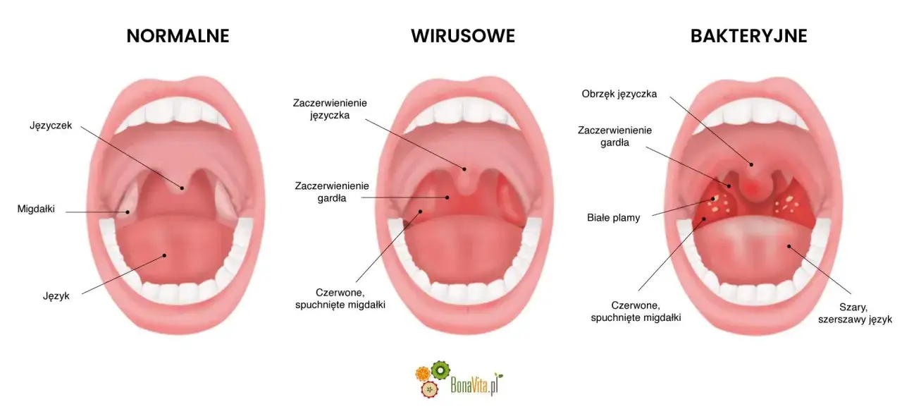 Porównanie gardła: normalne, wirusowe (bez antybiotyku na wirusy) i bakteryjne. Wirusowe objawy to zaczerwienienie języczka i gardła.
