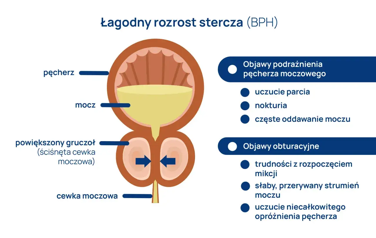 Ilustracja pokazuje łagodny rozrost stercza (BPH). Powiększony gruczoł uciska cewkę moczową, co prowadzi do objawów takich jak trudności z oddawaniem moczu.